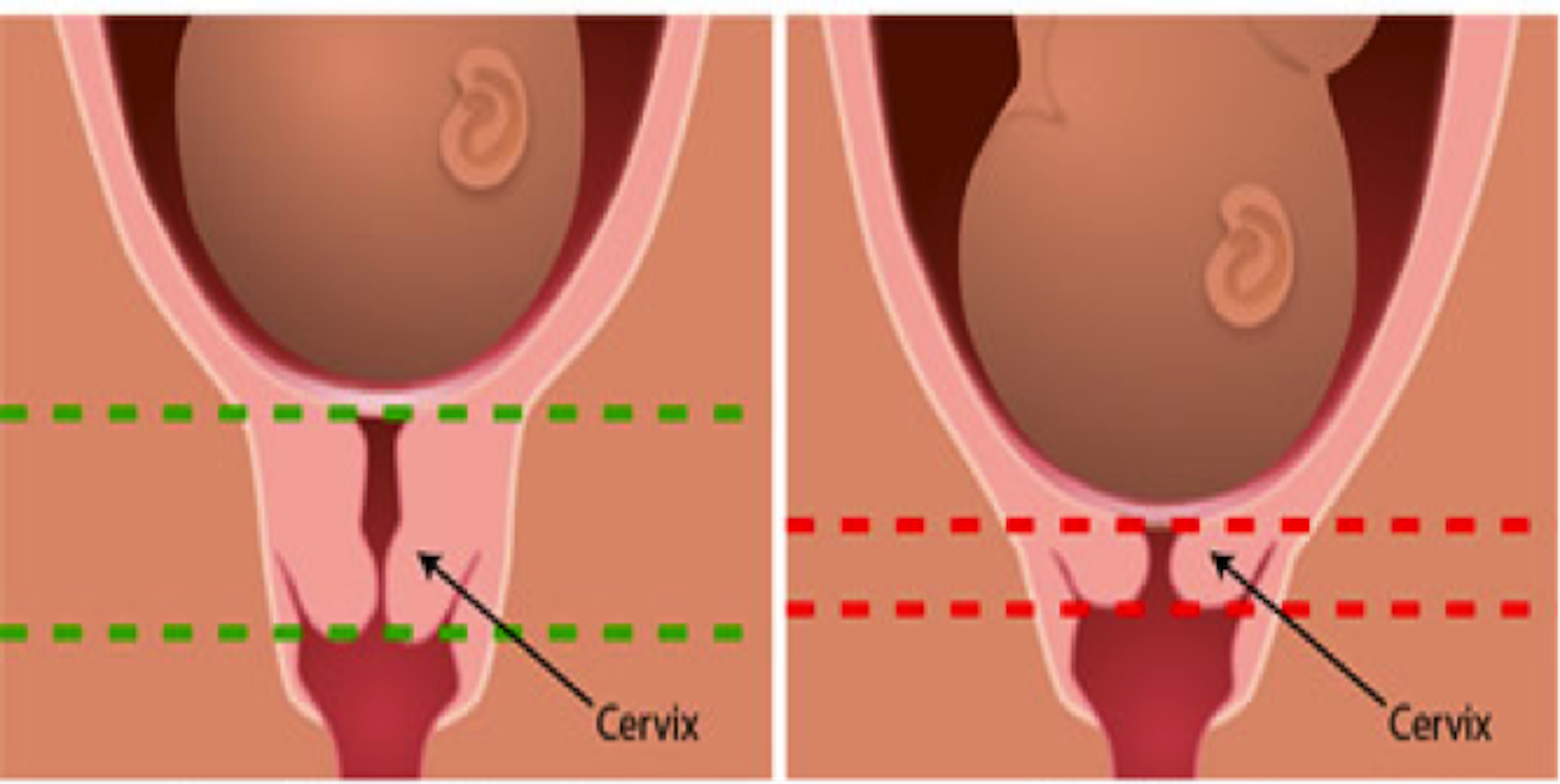 CERCLAJE DE CUELLO UTERINO